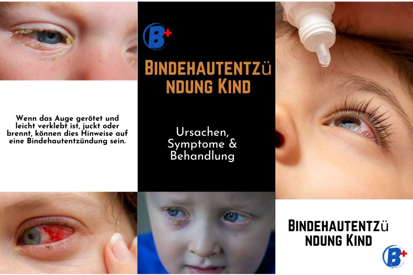 Bindehautentzündung Kind Ursachen Symptome Behandlung