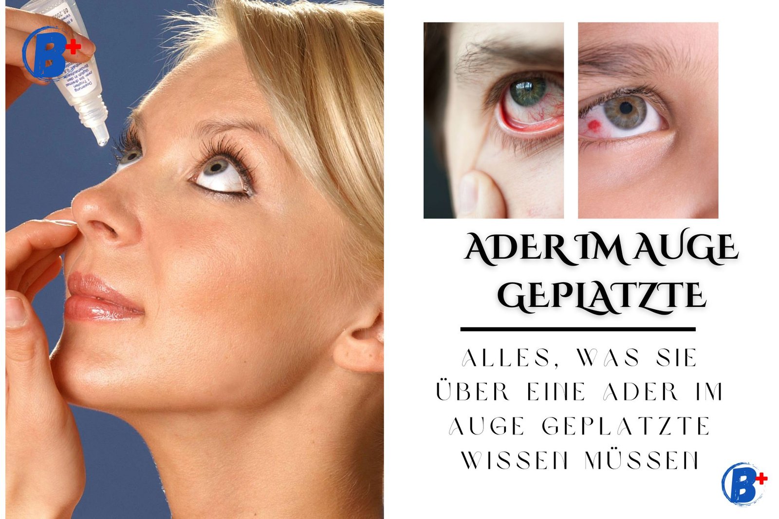 Ader Im Auge Geplatzt