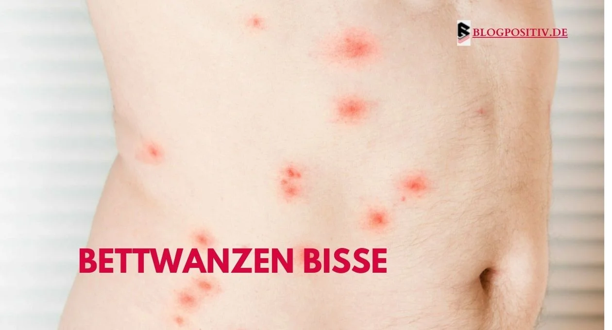 Bettwanzen Bisse Erkennen Und Vorbeugen
