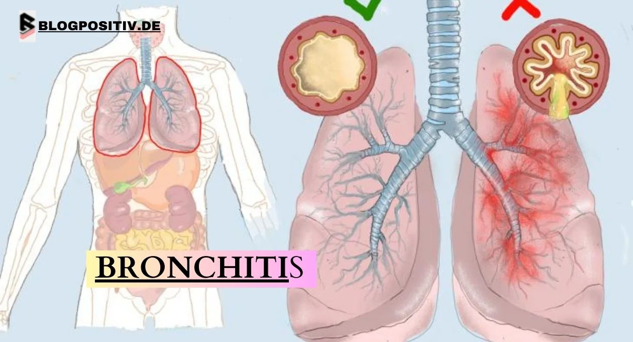 bronchitis ansteckend